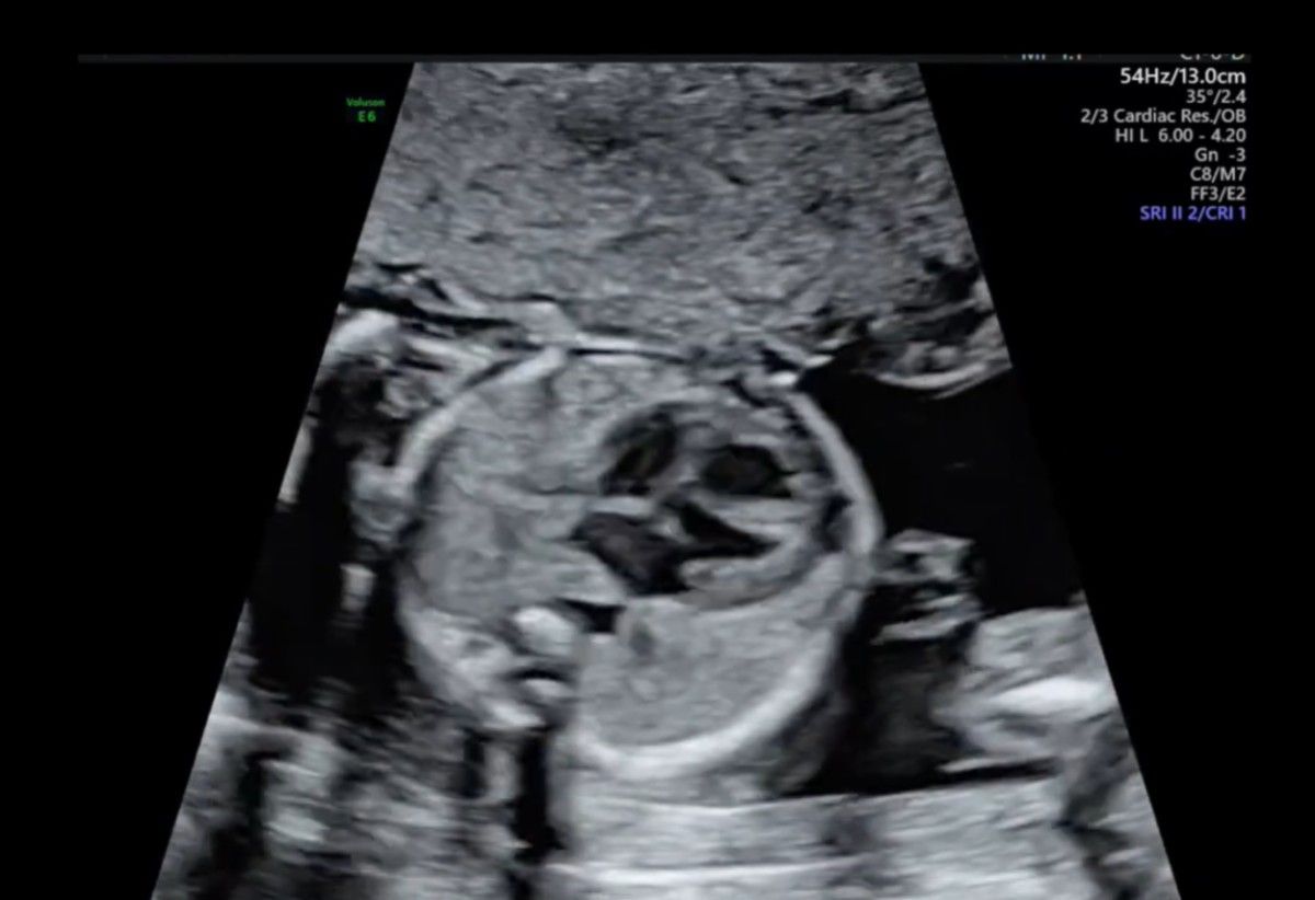 Educational images / clips for Fetal Echocardiography